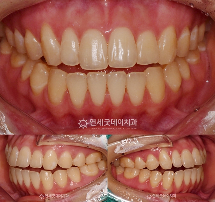 턱관절교정 전 어금니를 제외한 모든 치아가 닿지 않음