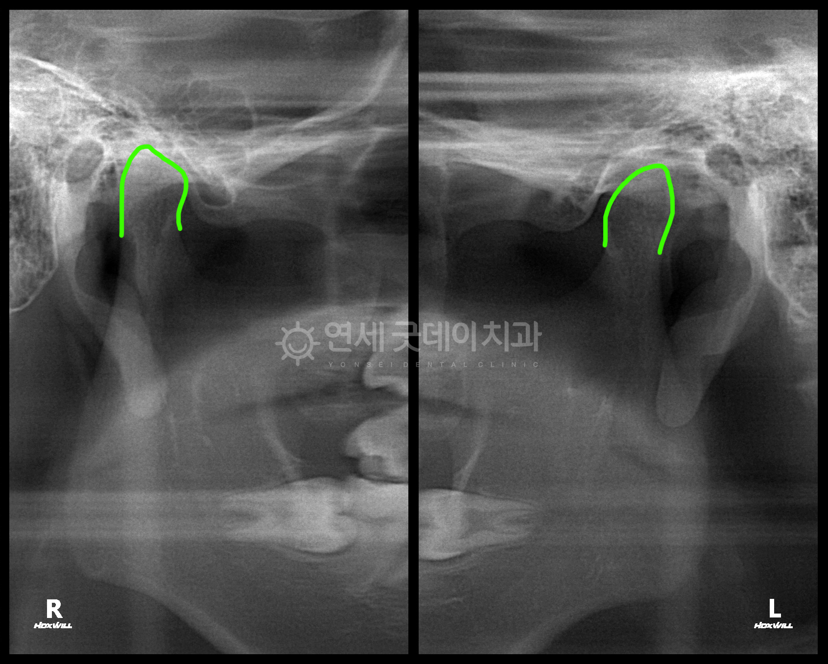 턱관절 퇴행성관절염으로 닳은 턱뼈, 스플린트로 턱관절교정 치료계획 수립
