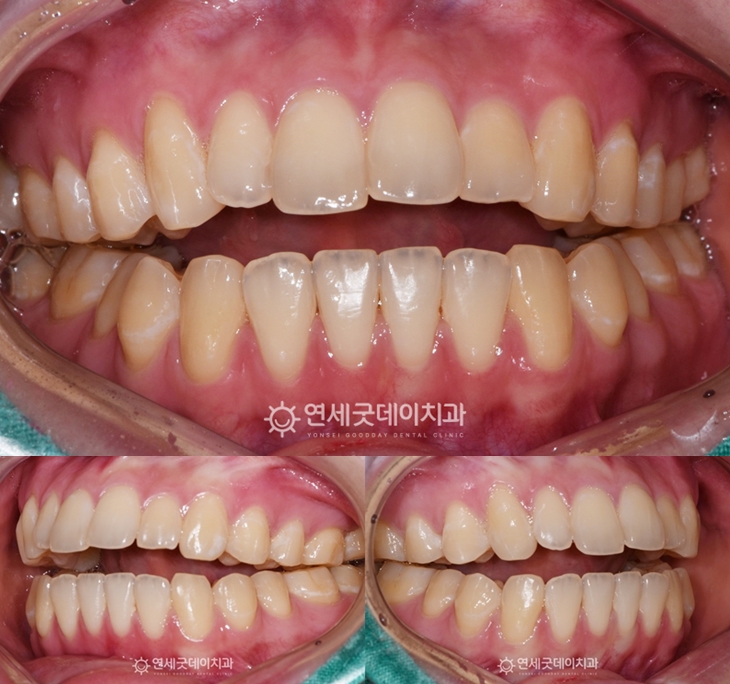 턱관절교정 후 턱뼈가 안정되면서 숨었던 개방교합이 드러남