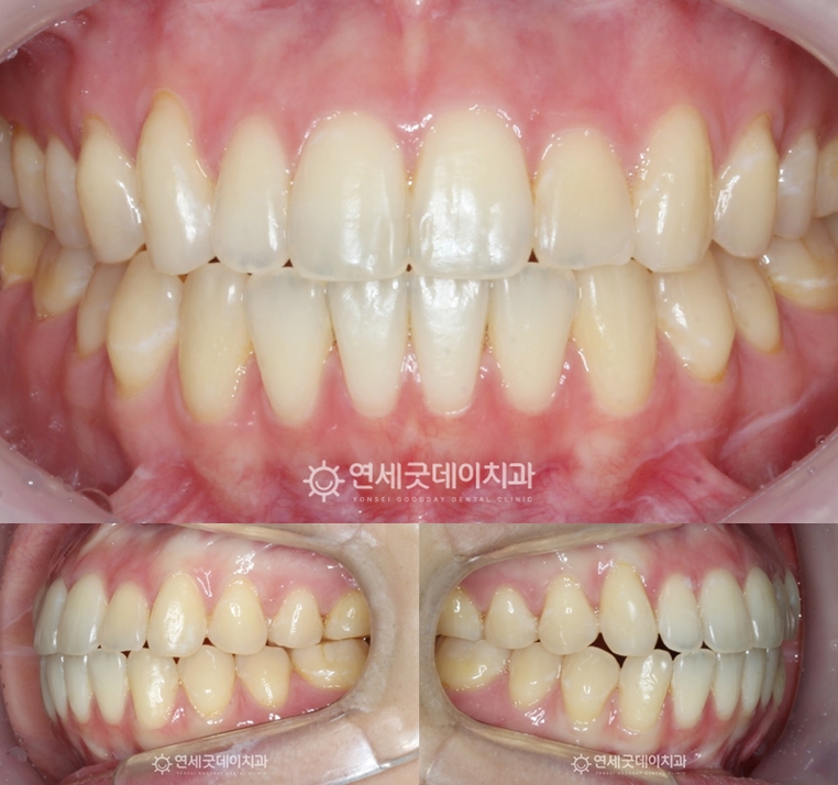 스플린트 턱관절교정 후 인비절라인 교정을 통해 개방교합 개선