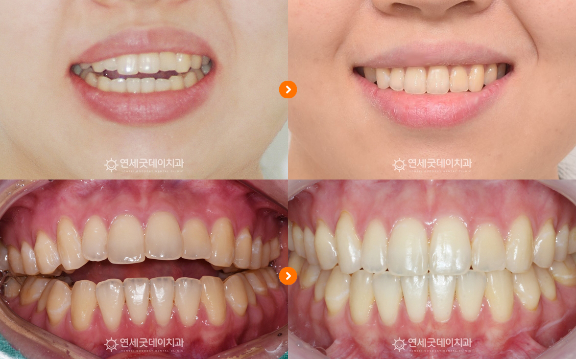 턱관절교정 및 개방교합 치료전과 후 모습