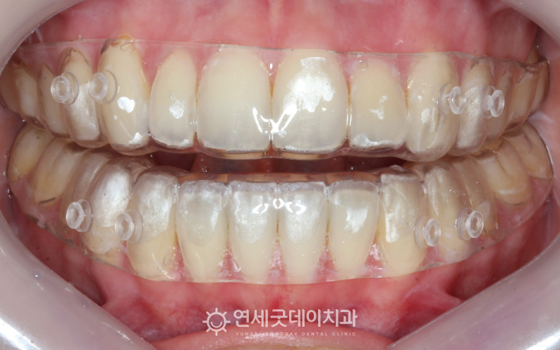 개방교합을 방지하고 턱관절교정 효과를 지속하기 위해 트랙션 유지장치 사용