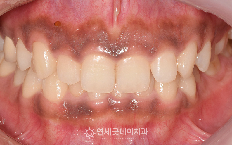 잇몸검은색, 까만잇몸이 두드러지게 관찰되는 모습