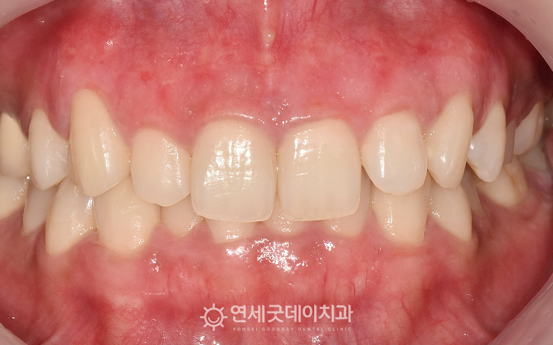 잇몸미백 후 까만잇몸, 잇몸검은색이 개선된 모습