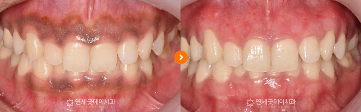 까만잇몸으로 인해 잇몸미백 시술 진행하였으며 치료전후 비교