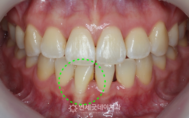 치주교정 전 - 치아뿌리가 잇몸뼈 밖으로 튀어나와 재교정 희망하심