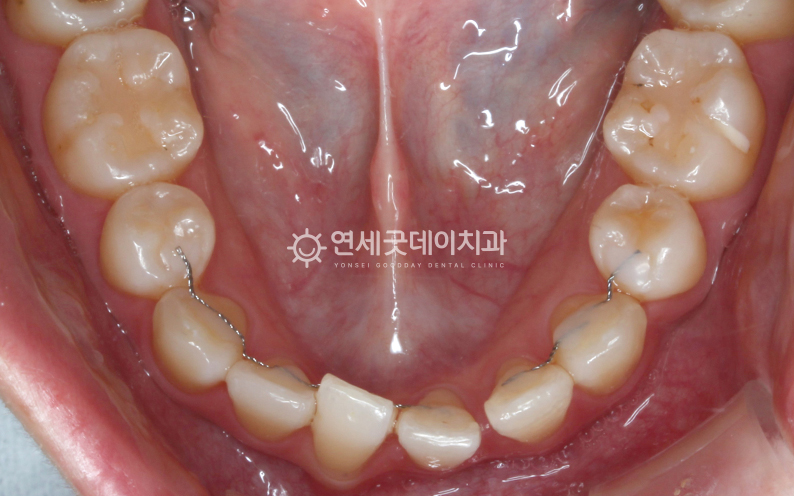 치주교정 전 - 재교정을 통해 틀어진 치아와 벌어진 공간 폐쇄 희망