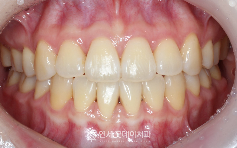 치주교정 후 - 재교정을 통해 치아의 위치 개선 및 잇몸퇴축도 완화됨