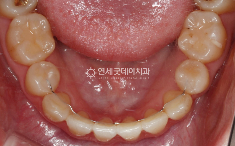 치주교정 후 구내모습