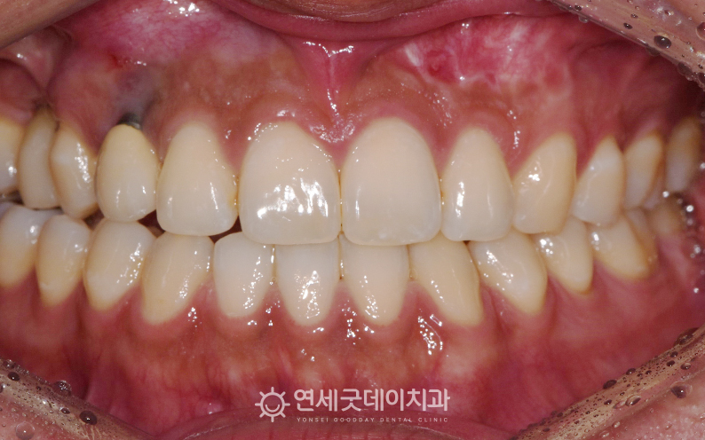 잇몸이식과 임플란트 재수술을 희망하여 내원해주심 (치료전)