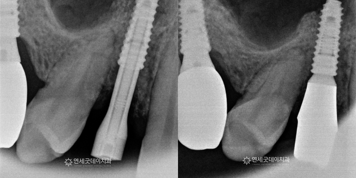임플란트 재수술과 잇몸이식 치료 진행 중