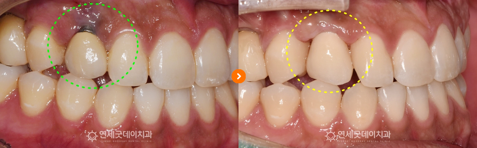 잇몸이식과 임플란트 재수술 전후 비교사진 (구내)