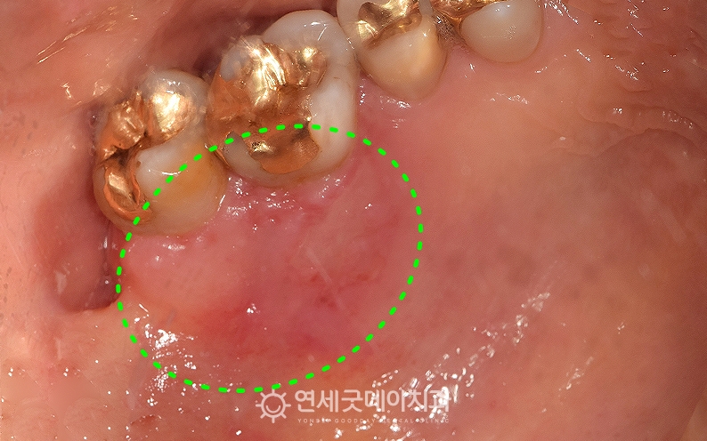잇몸궤양 치료전 구내모습, 광범위한 염증 관찰됨