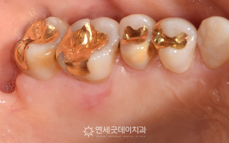 광범위한 잇몸궤양 - PDRN 주사 치료 1주일 뒤 구내모습