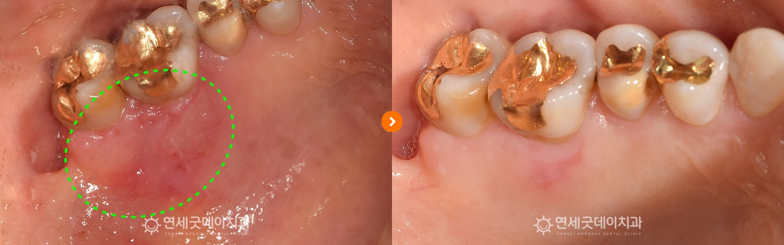 잇몸궤양 치료전후 구내모습 비교