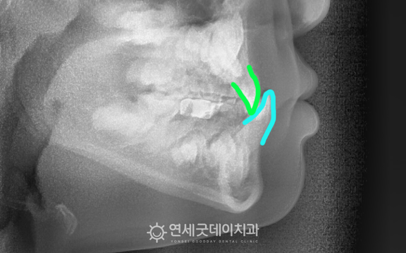 초등학생 부정교합(반대교합)으로 내원하여 엑스레이 촬영 진행