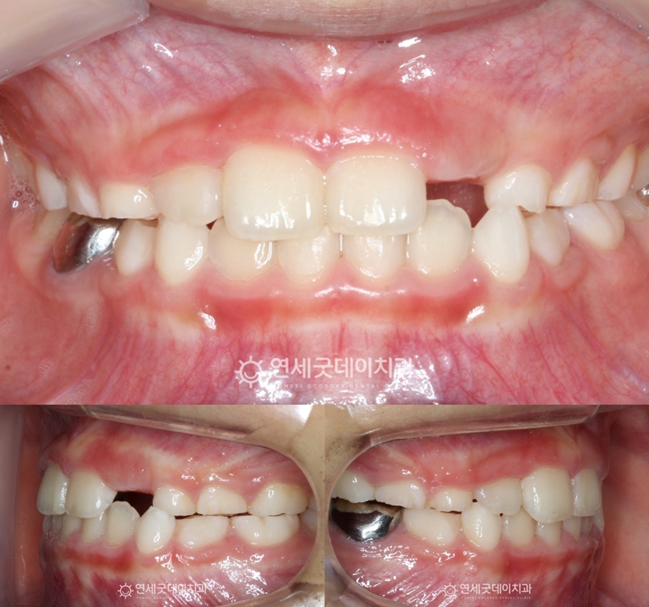 프리올소 치료를 통해 반대교합과 초등학생 부정교합 개선됨