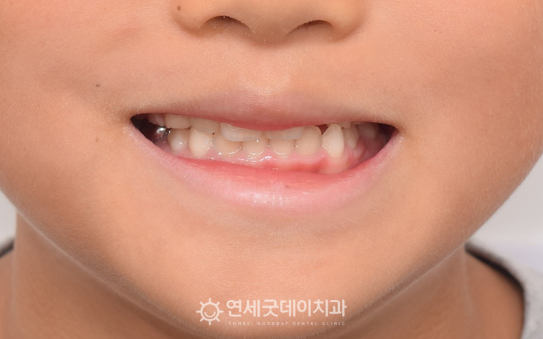 초등학생 부정교합 개선 후 얼굴의 균형이 맞춰짐