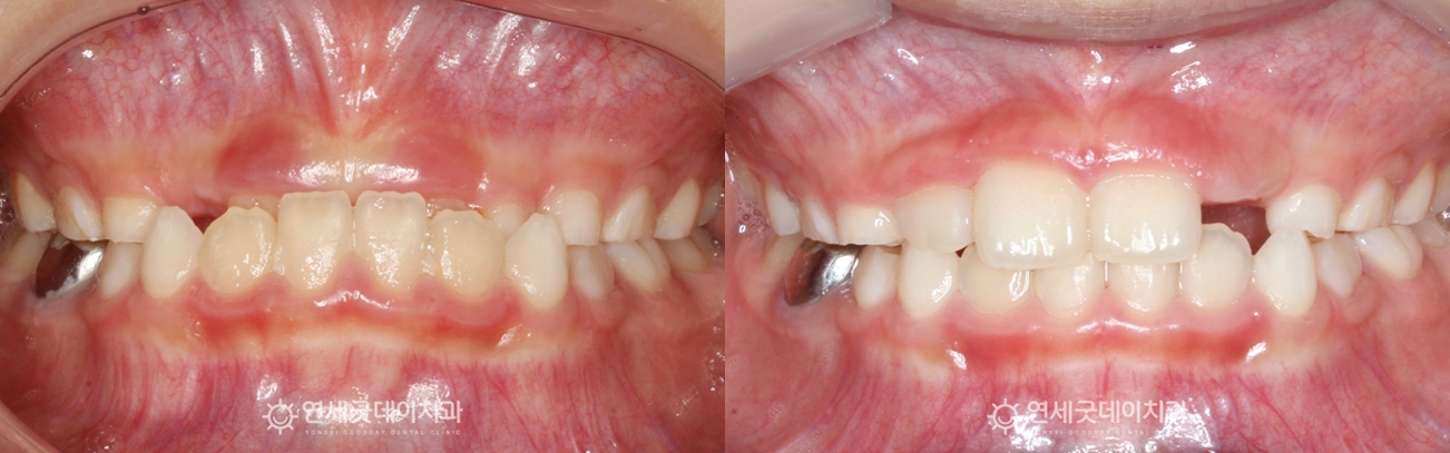 프리올소를 이용한 반대교합 치료전과 후를 비교함 (안모)