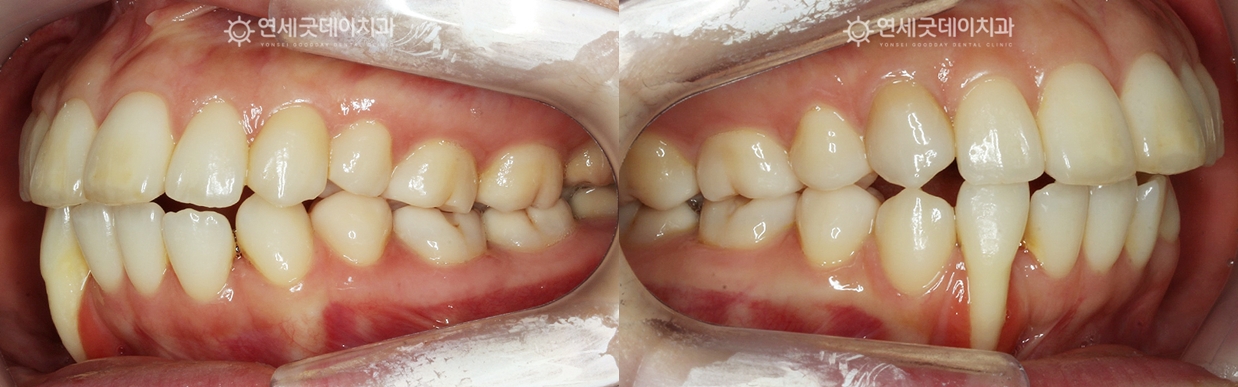 아랫니 부분교정 치료 전 측면사진으로 심한 잇몸퇴축 관찰됨