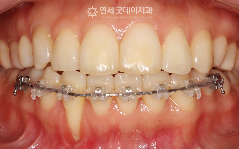 아랫니 부분교정으로 치주교정 진행 중인 ㅗ습