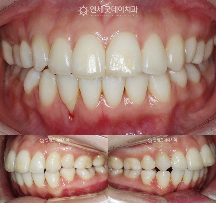 치주교정 종결 후 잇몸퇴축이 완화된 모습