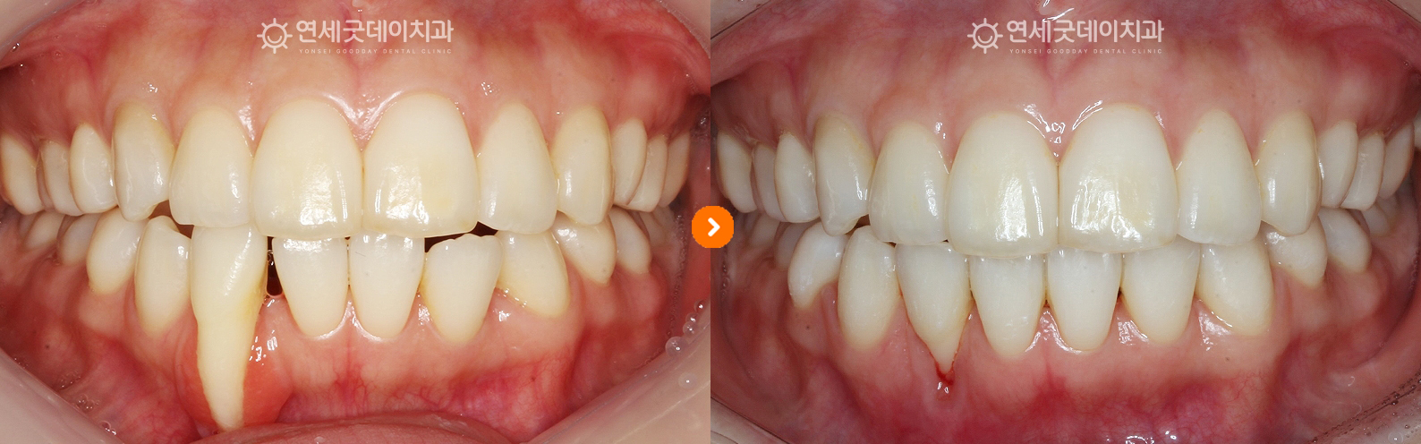 치주교정 - 아랫니 부분교정을 통한 잇몸퇴축 개선