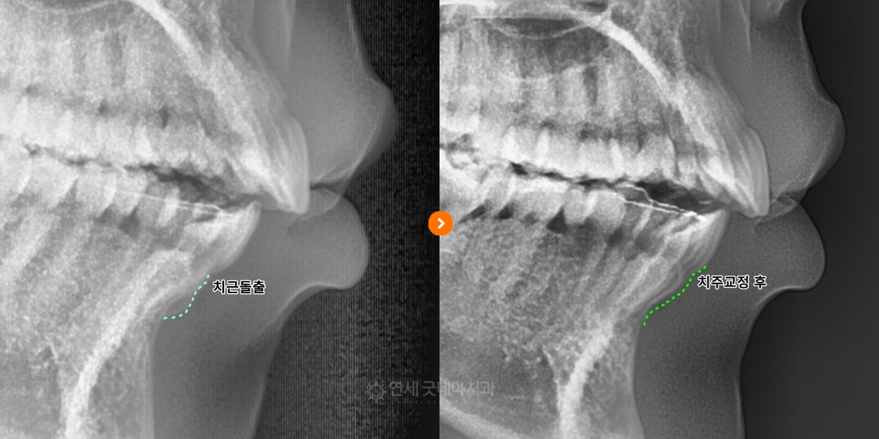치주교정 치료전후 엑스레이 비교 모습