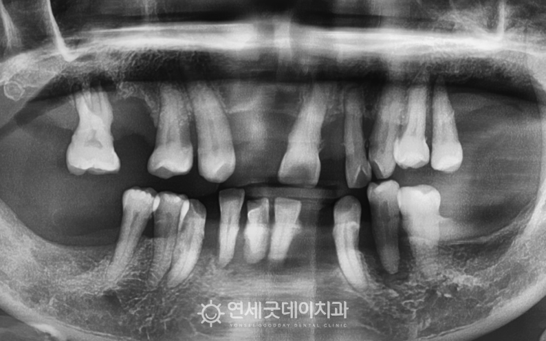 전체임플란트를 희망하여 내원하셨으며 치아가 빠지고 골소실이 상당수 진행됨