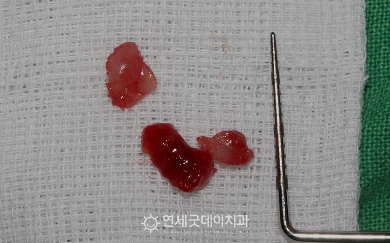 브릿지임플란트 치료전 치근낭적출술 시행함