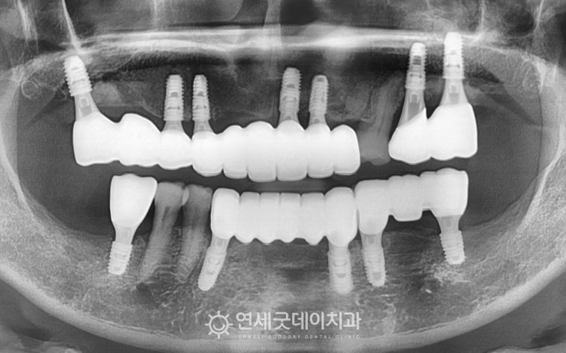 전체임플란트 치료 종결 후 엑스레이 모습 - 급속골이식으로 두꺼운 잇몸뼈 형성 및 브릿지임플란트 연결