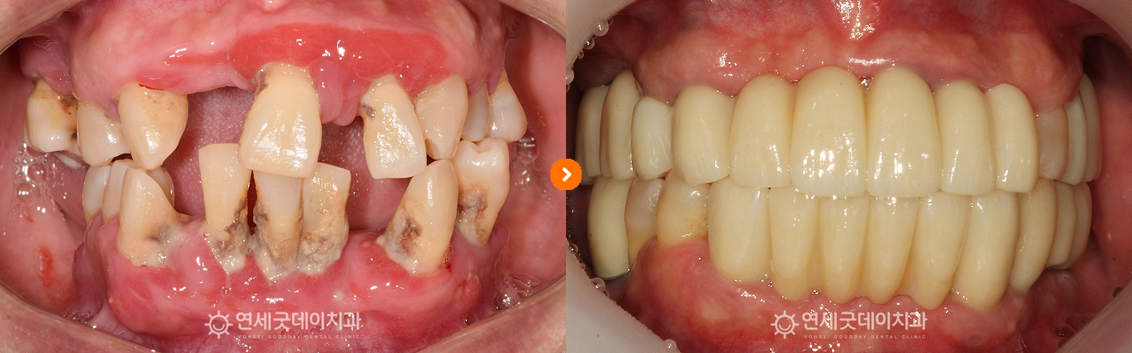 전체임플란트 치료전후를 비교한 구내모습이며 급속골이식과 브릿지임플란트로 기능 재건
