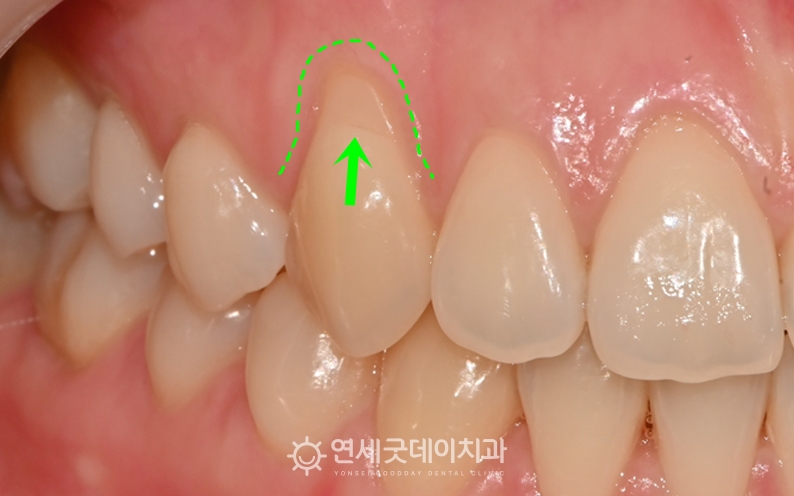 잇몸퇴축으로 인해 잇몸재생치료를 문의한 20대 환자분 - 치료전 모습