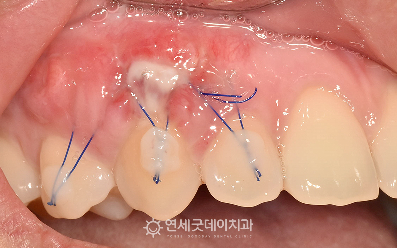 핀홀 잇몸재생치료 후 1주일 경과 모습