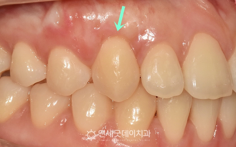 핀홀 잇몸재생치료 후 잇몸 외형이 회복된 모습