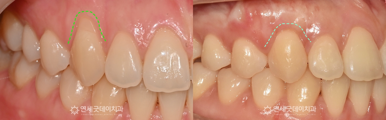 핀홀 잇몸재생치료 전후 구내모습