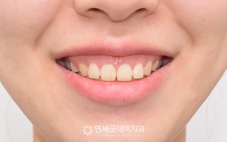 거미스마일을 주소로 구강전정술 희망, 치료전 안모