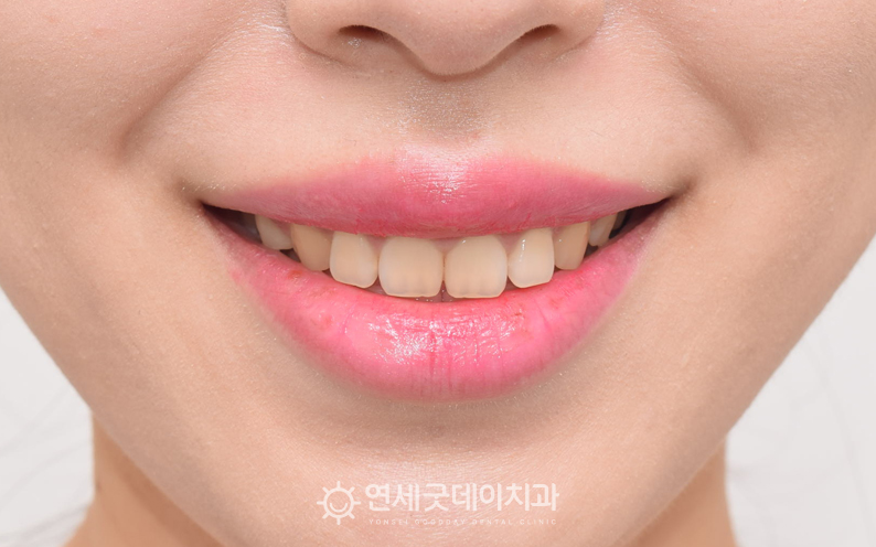 구강전정술 시술 후 1달 경과 안모