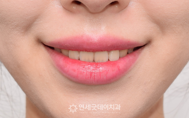 구강전정술 시술 후 4개월 경과, 거미스마일이 거의 완화된 모습