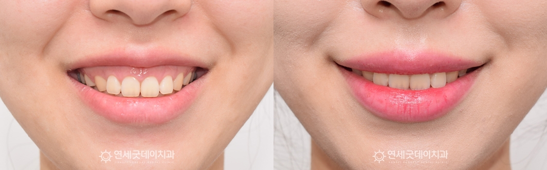 거미스마일 구강전정술 치료전후 안모의 변화