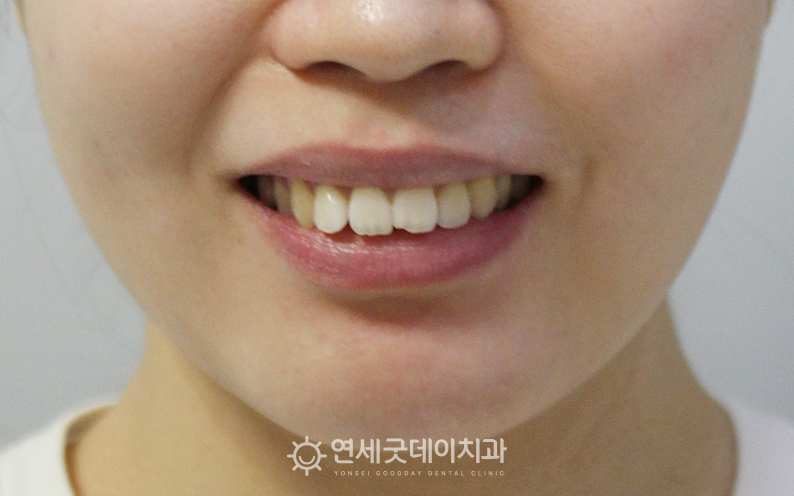 돌출입치아교정 전 안모