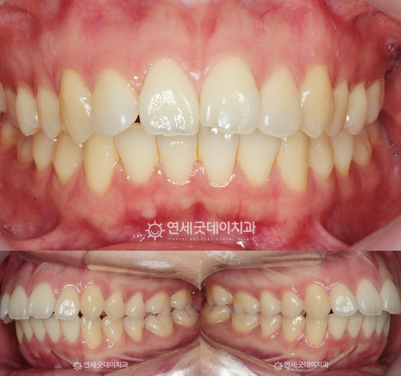 돌출입치아교정 전 구내포토이며 치아배열은 가지런하나 전치부가 돌출된 모습