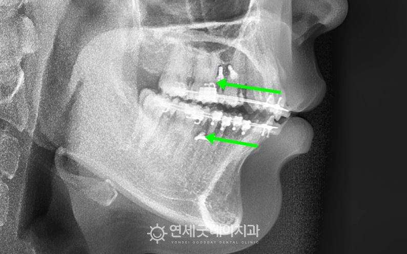 발치와 미니스크류를 동반한 돌출입치아교정 치료 중인 모습