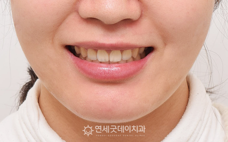 발치공간을 이용해 치아를 뒤로 이동시키고 돌출입치아교정이 완료된 모습