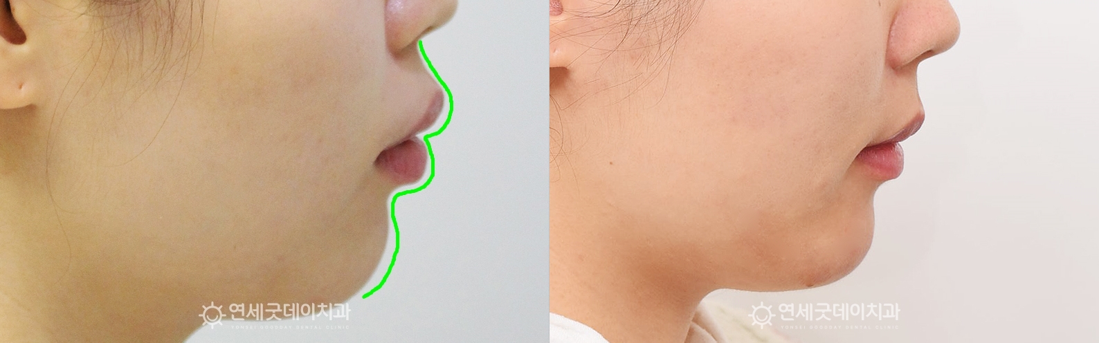 돌출입치아교정 전후 비교 - 턱선