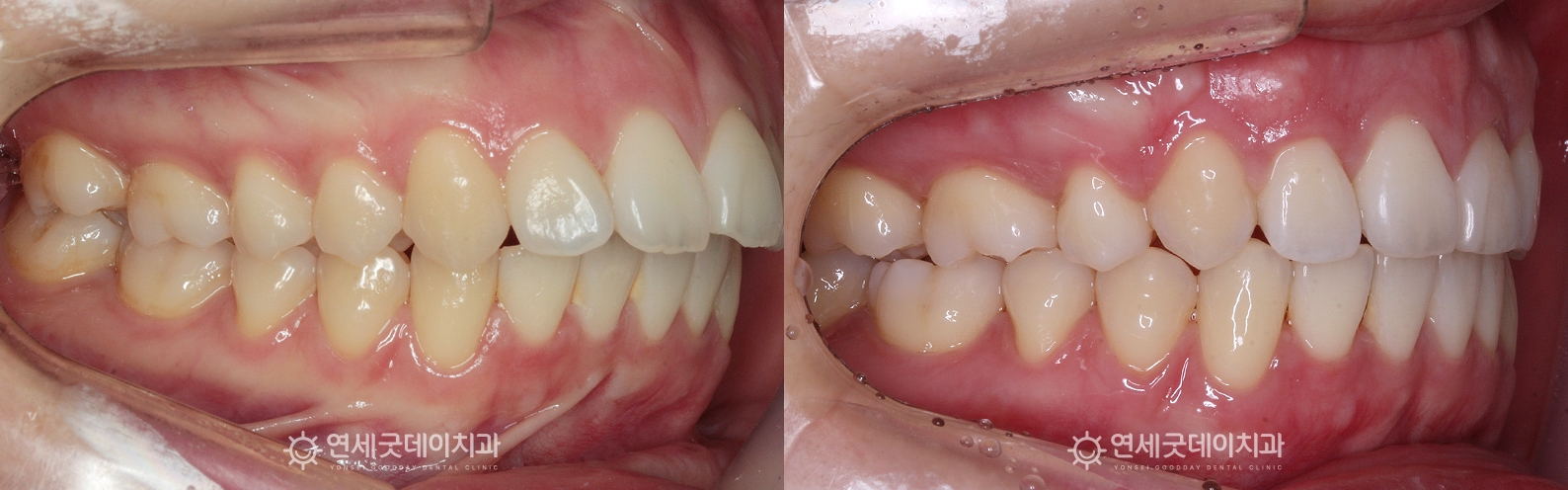 돌출입치아교정 전후 비교 - 앞니 각도와 교합의 변화