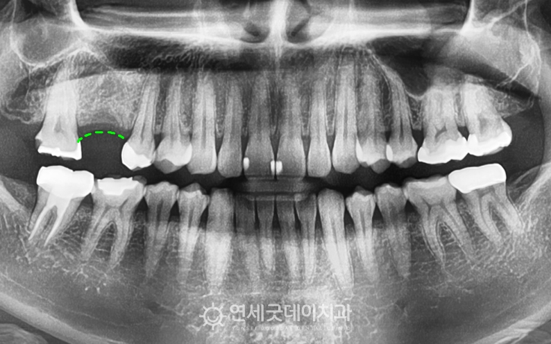 잇몸뼈소실로 잇몸뼈이식을 동반한 어금니 임플란트 치료계획을 세움