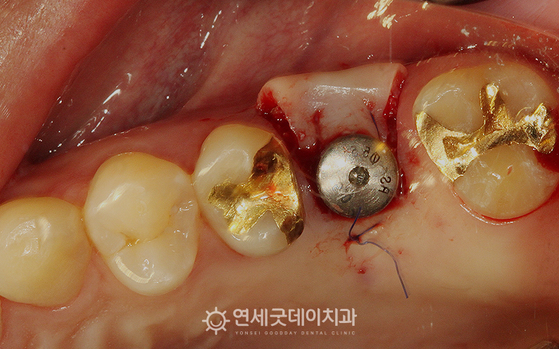 잇몸뼈이식 후 어금니 임플란트까지 심은 모습