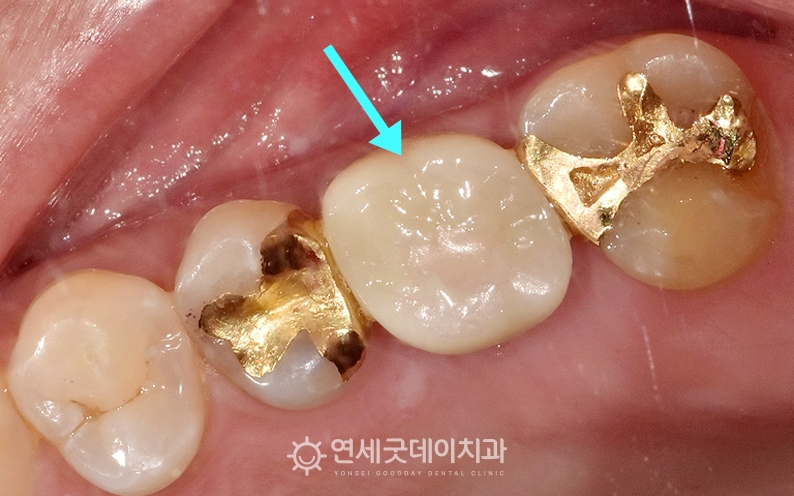 어금니 임플란트 치료 종료