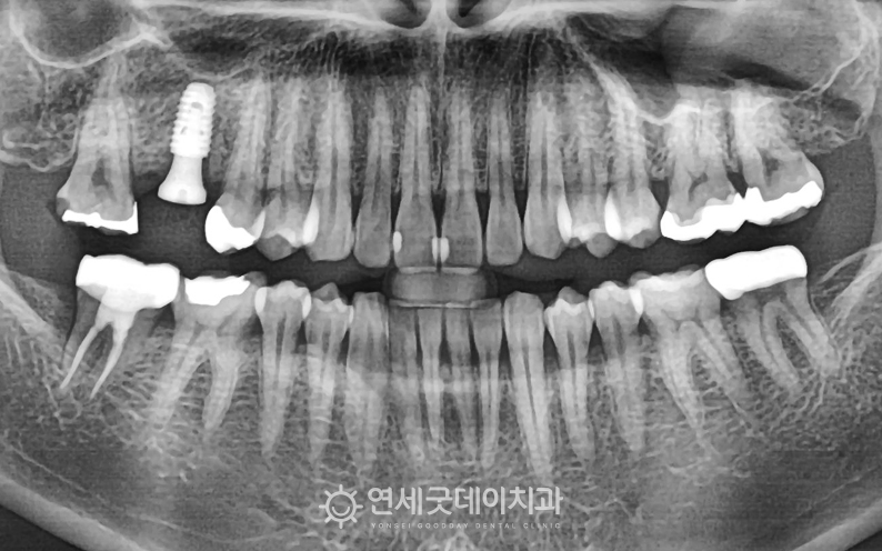 잇몸뼈이식으로 두꺼운 잇몸뼈가 확보되고, 픽스쳐가 잘 식립된 모습